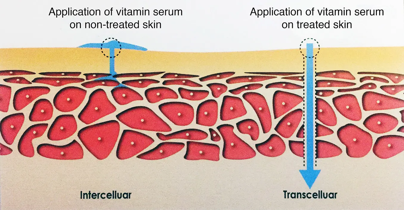 Micro-Needling Diagram
