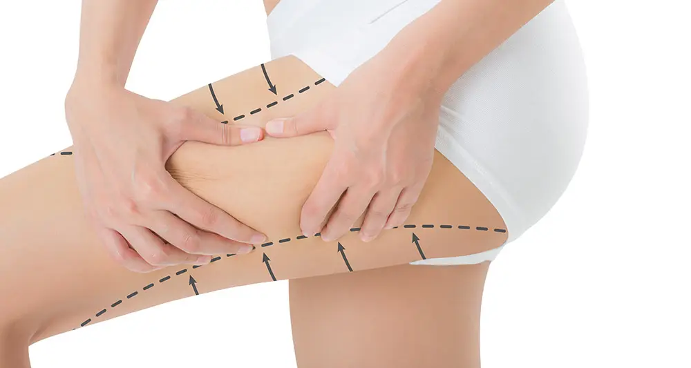 Shockwave Cellulite
