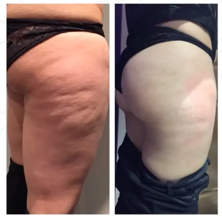 4 treatments of cavitation celluilte reduction