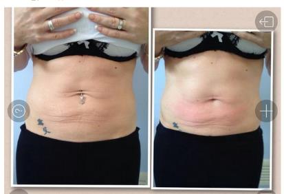 1 Radio Frequency treatment