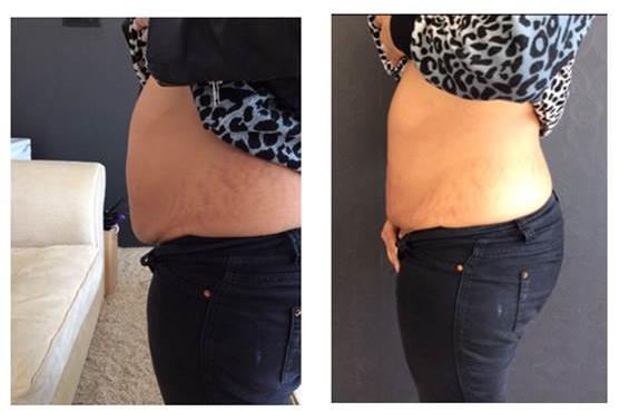 1 Session of Cavitation