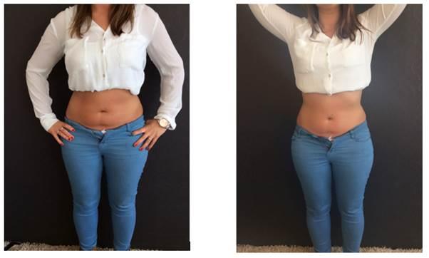 1 Session of Cavitation