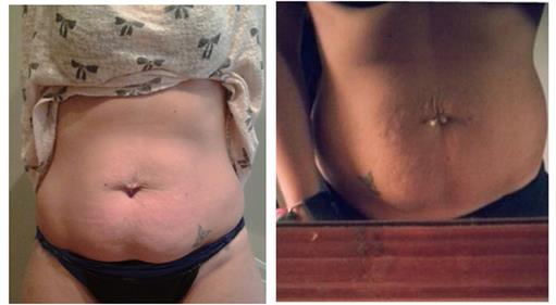 1 cryolipolysis treatment