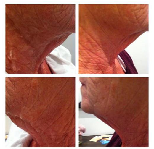 1 session of Radio Frequency on the neck area