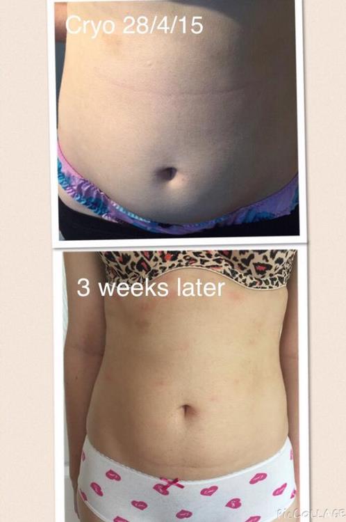 1 session of cryolipolysis
