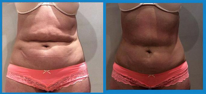 1 treatment of 3D- lipo