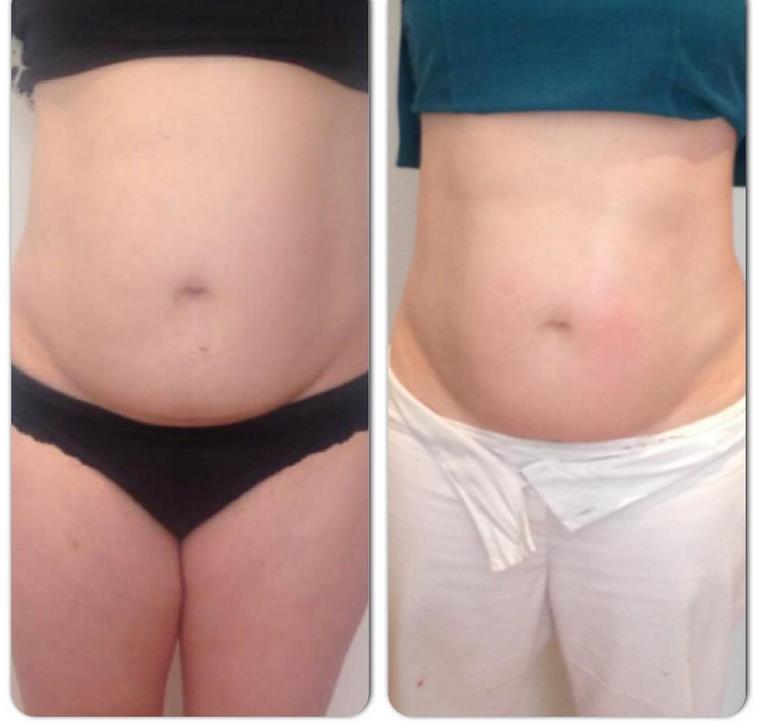 2 Cavitation Treatments