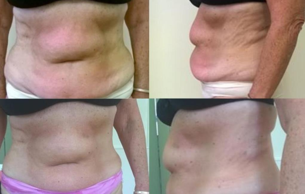 3 Cavitation treatments