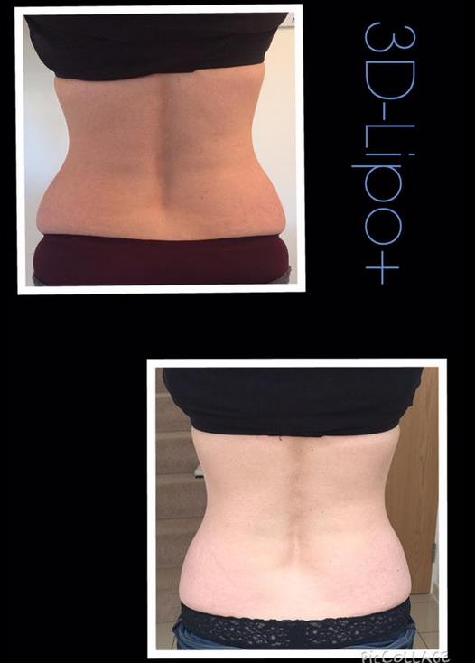 3 Treatments of 3D- lipo