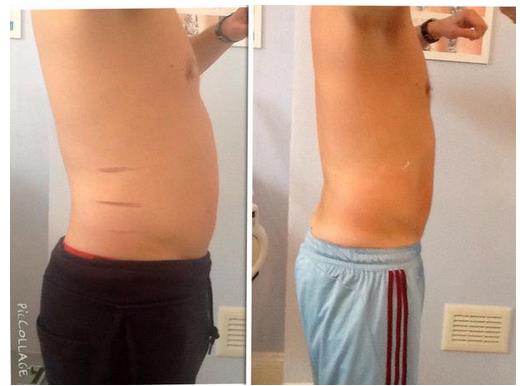 4 sessions of Cavitation