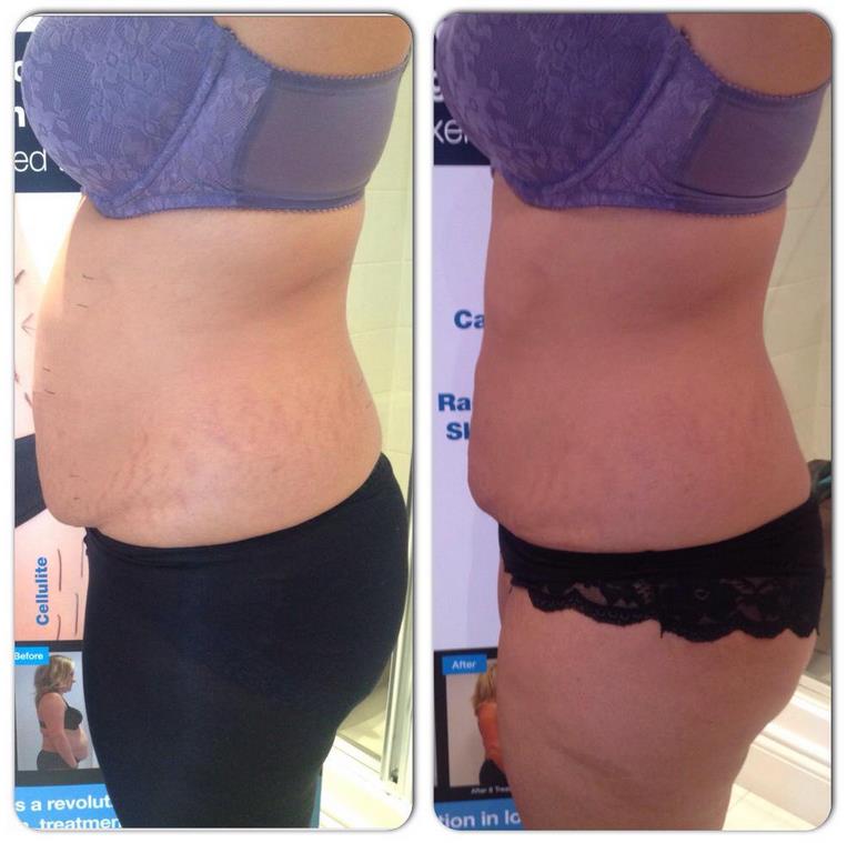 4 treatments of 3D- lipo