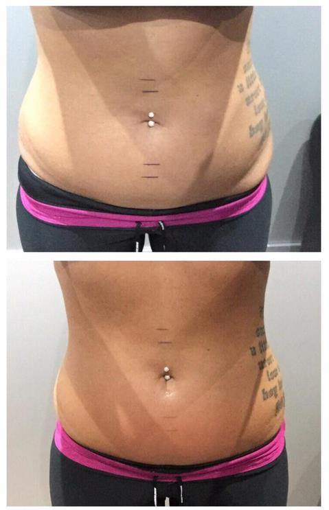 5 Sessions of 3D- lipo
