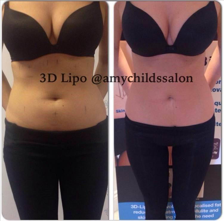 6 Treatments combining Cavitation, Radio Frequency and Vacuum Rolling