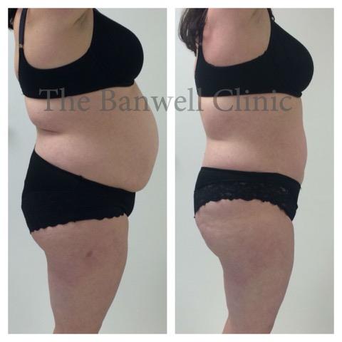 6 sessions of Cavitation and Radio Frequency