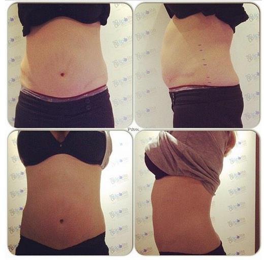 6 sessions of Cavitation
