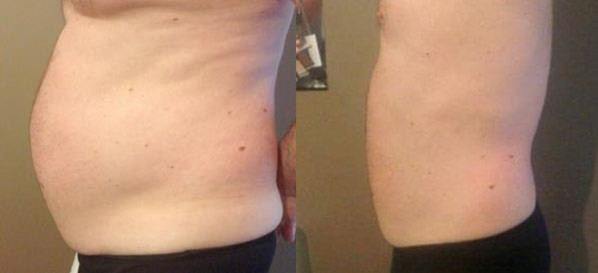 8 Sessions of Cavitation