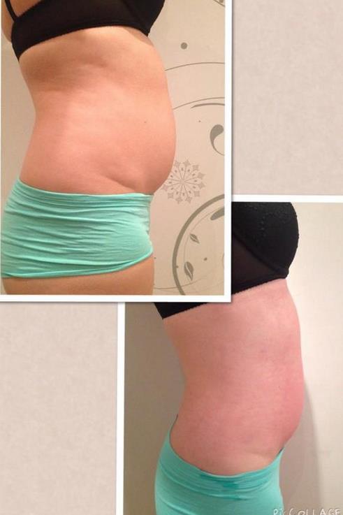 8 sessions of Cavitation