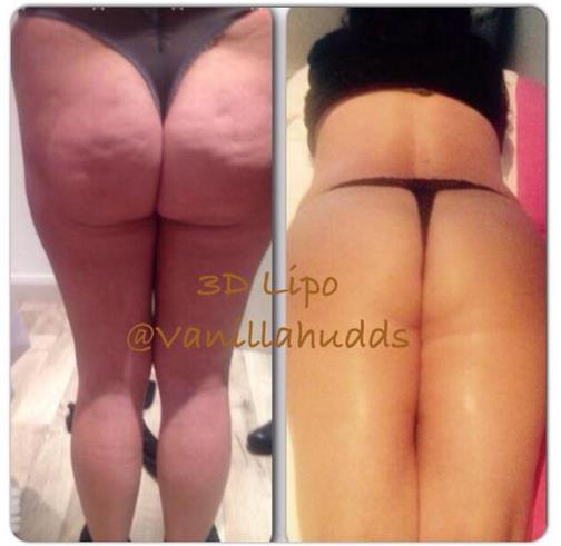 8 sessions of Cavitation combined with vacuum rolling
