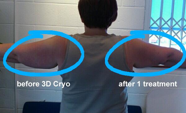 After 1 Session of Cryolipolysis