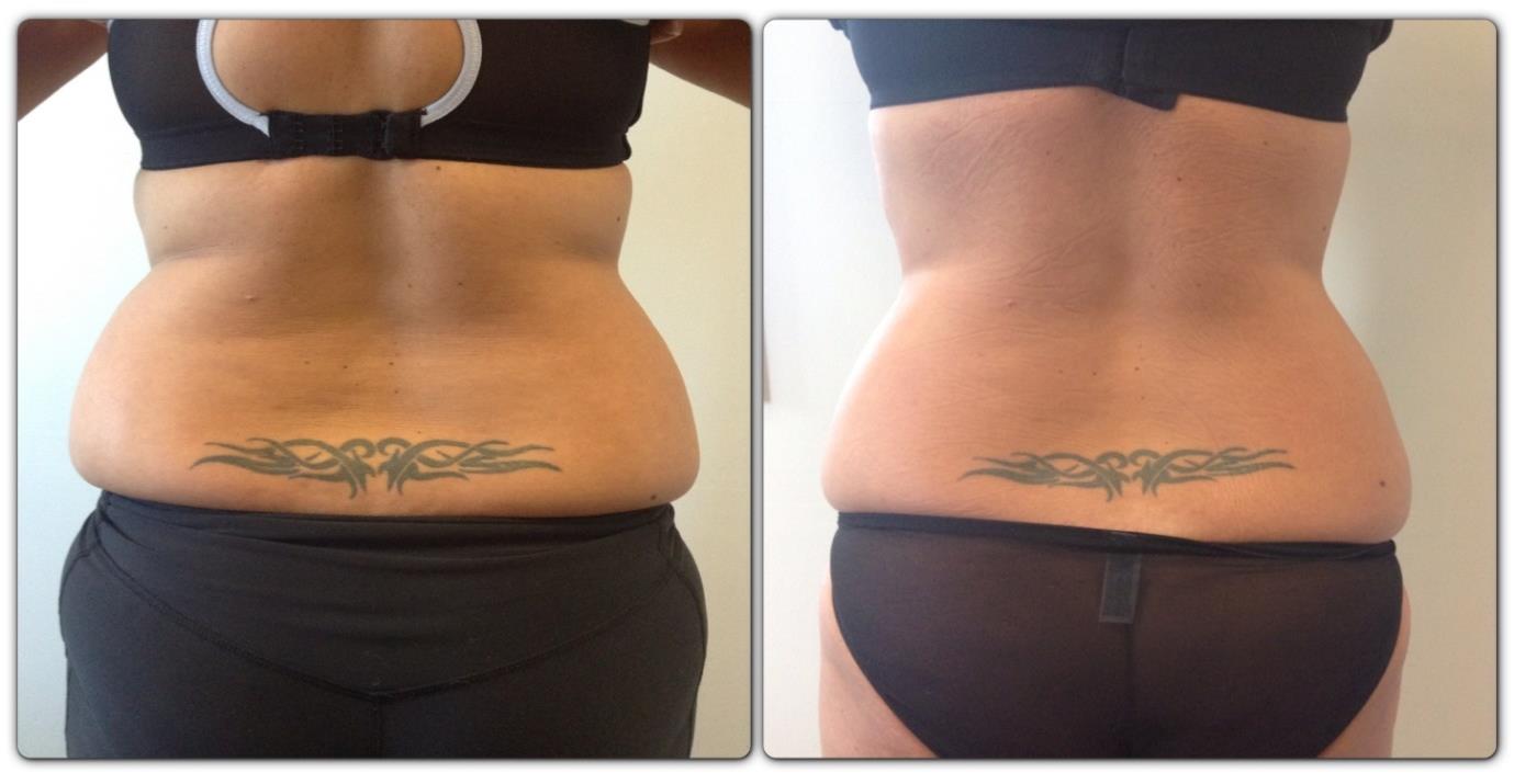 Course of 2 Cryolipolysis & 6 Cavitation