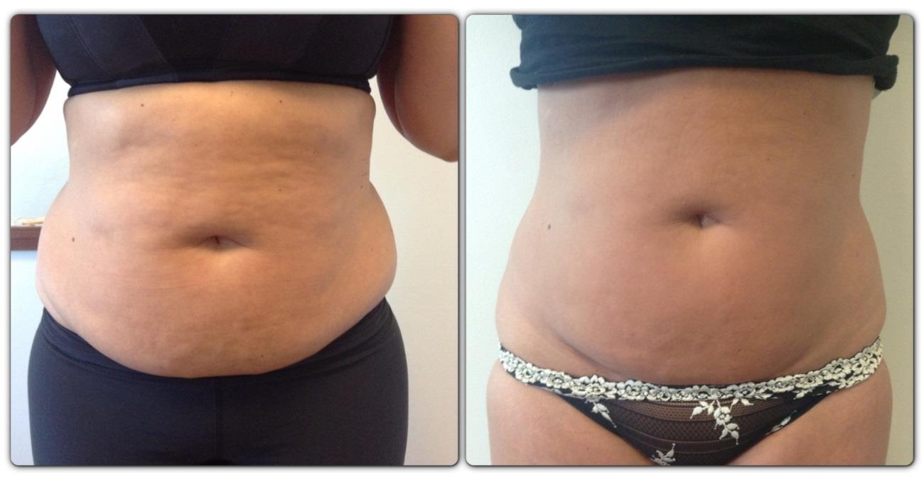 Course of 2 Cryolipolysis & 6 Cavitation