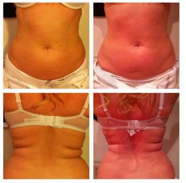 a Cavitation Treatment